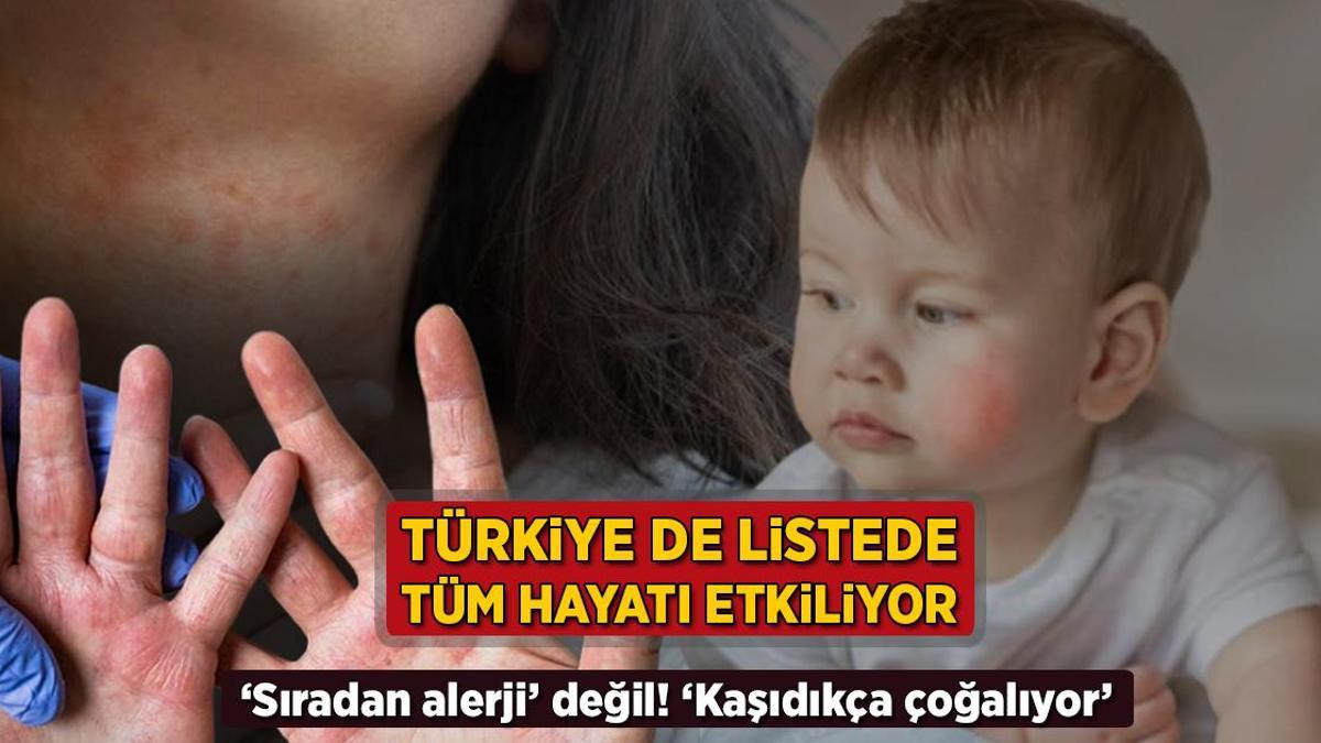 Türkiye de listede, tüm hayatı kötü etkiliyor! ‘Sıradan alerji’ değil: ‘Kaşıdıkça çoğalır’